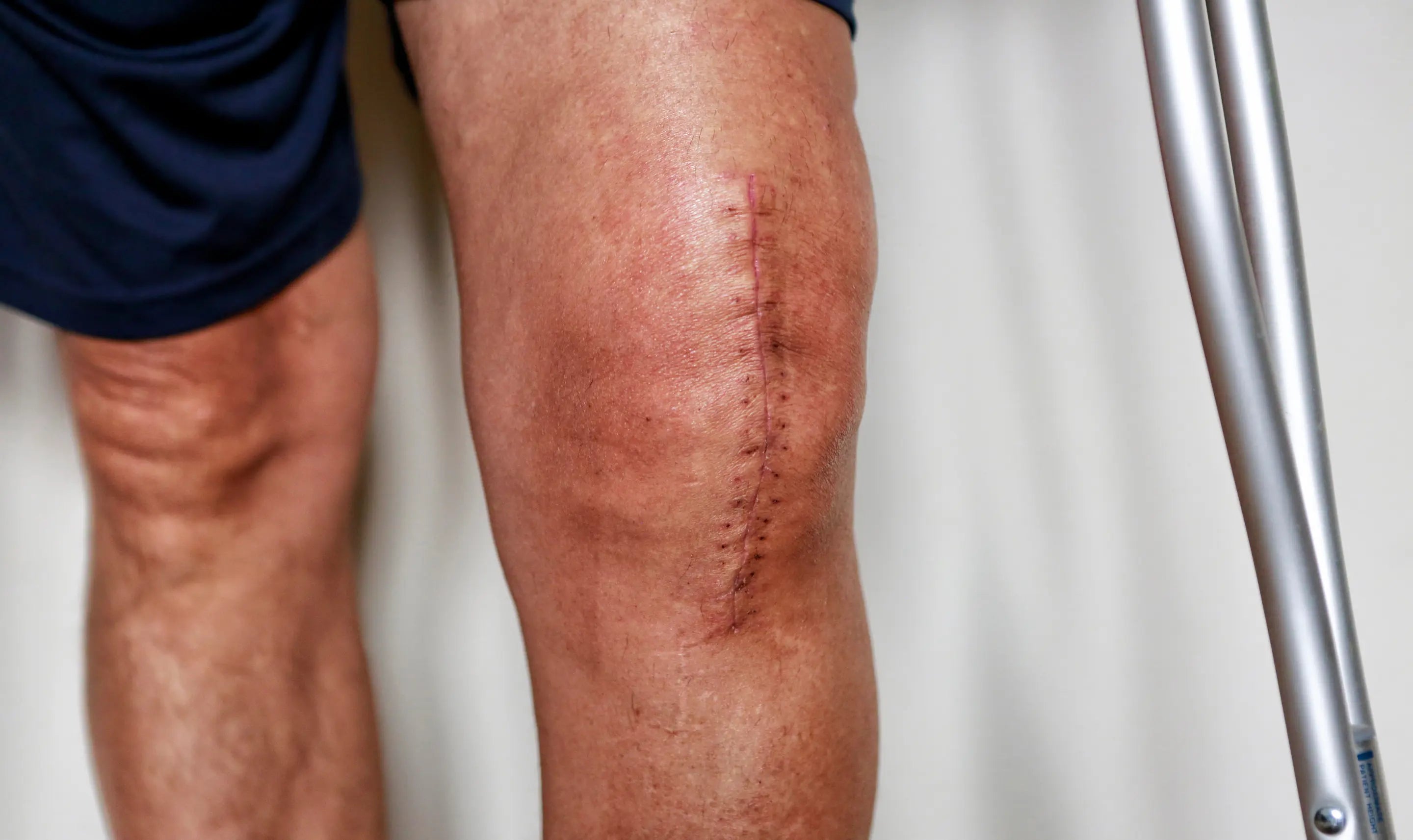 Managing Pain After Knee Replacement: What Actually Works